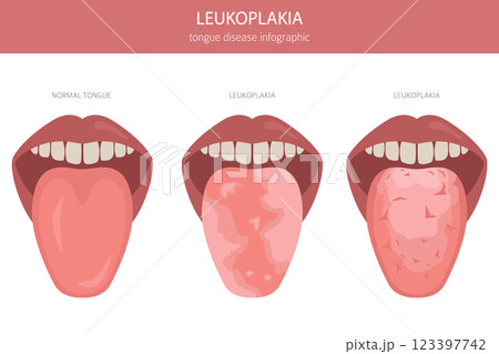 Leukoplakia tongue disease. Oral medicine. Medical infographic design 123397742