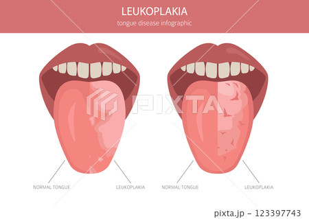 Leukoplakia tongue disease. Oral medicine. Medical infographic design 123397743