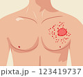 Medical illustration of a human chest with a skin rash, redness, and inflammation. Symptoms of skin infection, allergic reaction, or dermatological disease 123419737