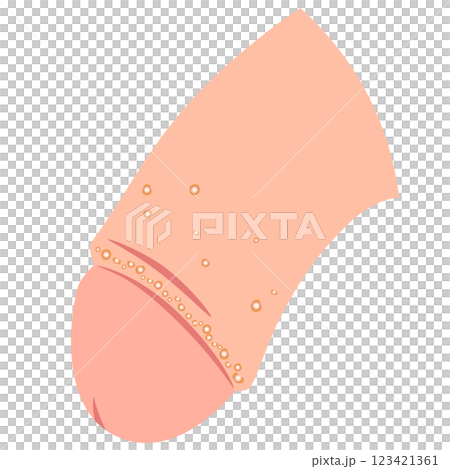 Fordyce spots: bumps on the male genitals Fordyce spots: bumps on the male genitals 123421361