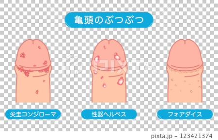 Bumps on male genitals - types of sexually transmitted diseases Bumps on male genitals - types of sexually transmitted diseases 123421374