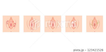 女性外性器の病気 123421526