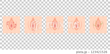 女性外性器の病気 123421526