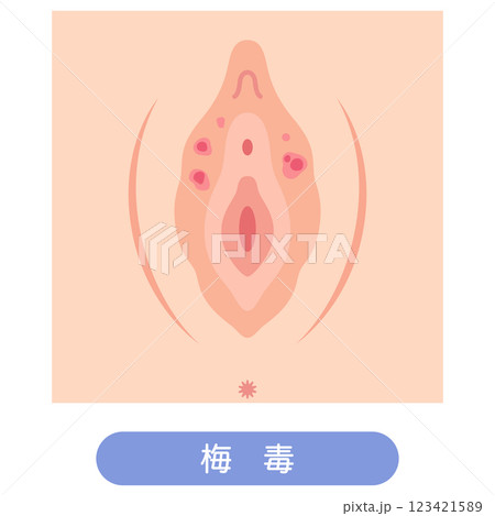 女性外性器の病気　梅毒 123421589