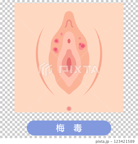 Diseases of the female external genitalia: Syphilis 123421589