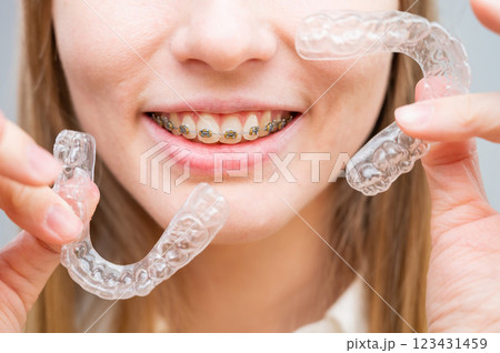 Woman with braces on her teeth holding and removable transparent aligners. Woman with braces on her teeth holding and removable transparent aligners. 123431459
