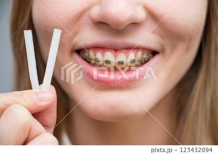 Close-up portrait of a woman with braces using special orthodontic wax. Close-up portrait of a woman with braces using special orthodontic wax. 123432094