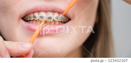 Unrecognizable Caucasian woman cleans braces with a brush. Close-up of female teeth with brackets 123432107