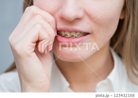 Close-up portrait of a red-haired girl suffering from pain due to braces. Young woman corrects bite with orthodontic appliance. 123432108