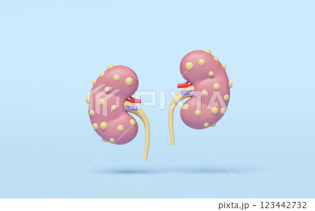 3d Chronic kidney disease or CKD isolated on blue background. world kidney day concept, 3d illustration render 123442732