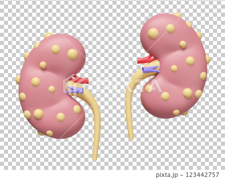3d Chronic kidney disease or CKD isolated. world kidney day concept, 3d illustration render 123442757