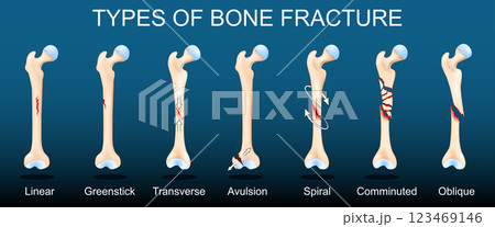 Broken Human femurs on dark background. Broken Human femurs on dark background. 123469146