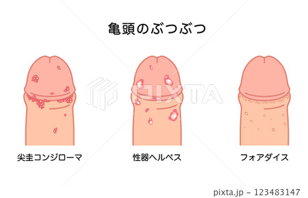 男性生殖器にできたぶつぶつ　性病の種類 123483147