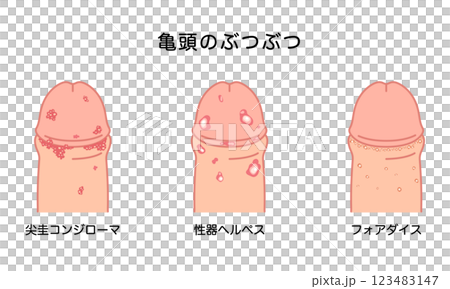 男性生殖器にできたぶつぶつ　性病の種類 123483147