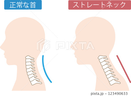 ストレートネック　ビフォアアフター 123490633