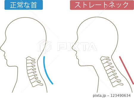 ストレートネック ビフォアアフター ストレートネック ビフォアアフター 123490634