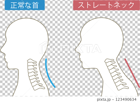ストレートネック ビフォアアフター ストレートネック ビフォアアフター 123490634