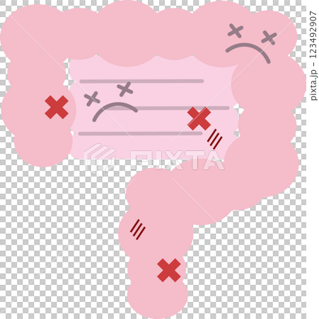 Illustration of an unhealthy and damaged small and large intestine Illustration of an unhealthy and damaged small and large intestine 123492907