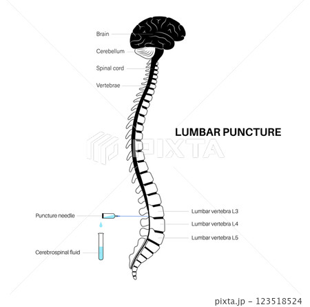 Lumbar puncture spinal tap Lumbar puncture spinal tap 123518524