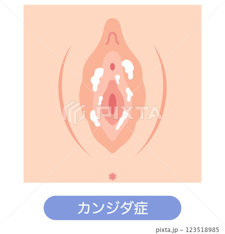 女性外性器の病気　カンジダ症 123518985