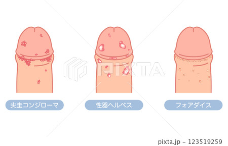 男性生殖器にできたぶつぶつ 性病の種類 男性生殖器にできたぶつぶつ 性病の種類 123519259