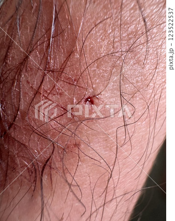 Close-up of a fresh wound on hairy skin 123522537