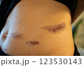 外科手術後の傷跡の経過 ― 腹部の皮膚再生と傷痕ケアのメディカルイメージ 123530143