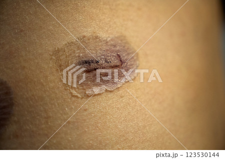 外科手術後の傷跡の経過 ― 腹部の皮膚再生と傷痕ケアのメディカルイメージ 外科手術後の傷跡の経過 ― 腹部の皮膚再生と傷痕ケアのメディカルイメージ 123530144