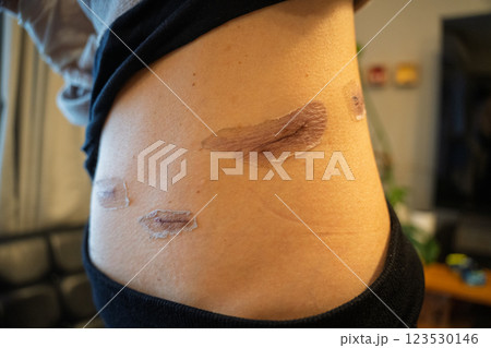 外科手術後の傷跡の経過 ― 腹部の皮膚再生と傷痕ケアのメディカルイメージ 123530146