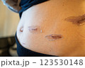 外科手術後の傷跡の経過 ― 腹部の皮膚再生と傷痕ケアのメディカルイメージ 123530148