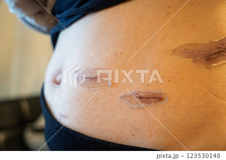 外科手術後の傷跡の経過 ― 腹部の皮膚再生と傷痕ケアのメディカルイメージ 123530148