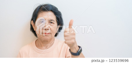 Elderly Woman with eye protective shield after eye surgery. Eye disease, Cataract,  Glaucoma, Age Related Macular Degeneration, Diabetic Retinopathy, Vitreous, Lasik, World Glaucoma day and health 123539696
