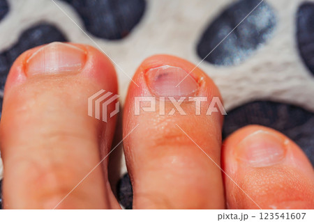 the toes of an adult man. damage to a guy's toenail after running. bare foot 123541607