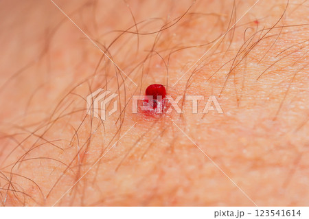 Leg injury in a girl. A severe injury while running in the mountains. Leg injury in a girl. A severe injury while running in the mountains. 123541614