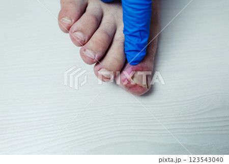 Finger infection. Paronychia, onychomycosis, nail psoriasis, longitudinal melanonychia, onychomadesis and retronychia. Inflammation of the big toe. Treatment of purulent diseases. 123543040