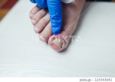 Finger infection. Paronychia, onychomycosis, nail psoriasis, longitudinal melanonychia, onychomadesis and retronychia. Inflammation of the big toe. Treatment of purulent diseases. 123543041