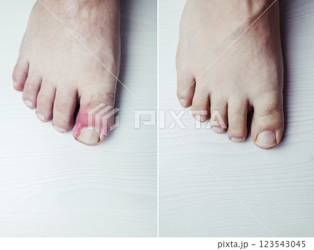 Before and after. Finger infection. Paronychia, onychomycosis, nail psoriasis, longitudinal melanonychia, onychomadesis and retronychia. Inflammation of the big toe. Treatment of purulent diseases. 123543045