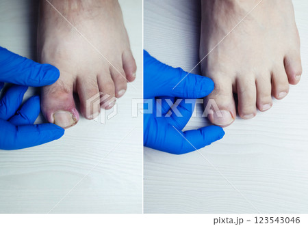 Before and after. Finger infection. Paronychia, onychomycosis, nail psoriasis, longitudinal melanonychia, onychomadesis and retronychia. Inflammation of the big toe. Treatment of purulent diseases. 123543046