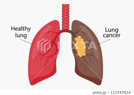 Illustration of healthy lung and lung cancer. 123547634