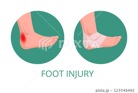 Foot injury medical treatment. Human body part first aid infographic, injured leg part first aid methods flat vector illustration. Cartoon bandaging 123548492