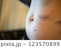 外科手術後の傷跡の経過 ― 腹部の皮膚再生と傷痕ケアのメディカルイメージ 123570899