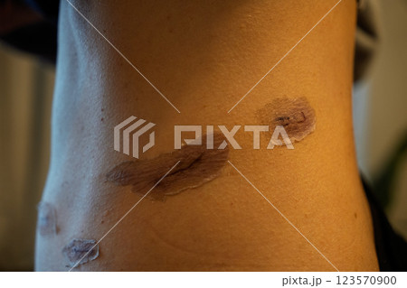 外科手術後の傷跡の経過 ― 腹部の皮膚再生と傷痕ケアのメディカルイメージ 123570900