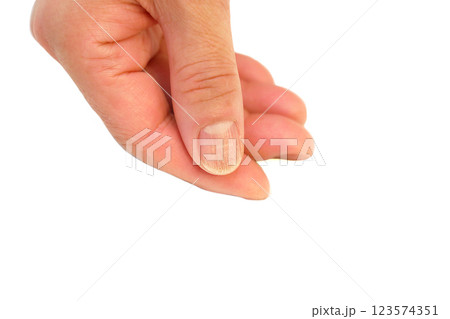 爪に縦筋 爪に縦筋 123574351
