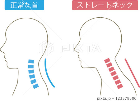 ストレートネック ビフォアアフター ストレートネック ビフォアアフター 123579300