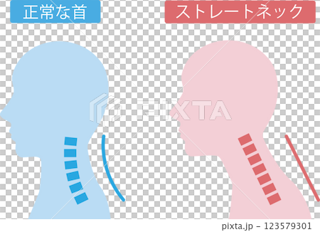 ストレートネック ビフォアアフター ストレートネック ビフォアアフター 123579301