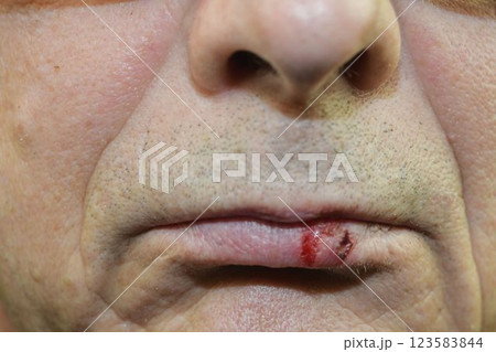Oral herpes on the lip. Cold sore on the mouth. Fever blister on lips. The concept of health and vitamins Oral herpes on the lip. Cold sore on the mouth. Fever blister on lips. The concept of health and vitamins 123583844