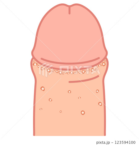 フォアダイス　男性生殖器にできたぶつぶつ 123594100