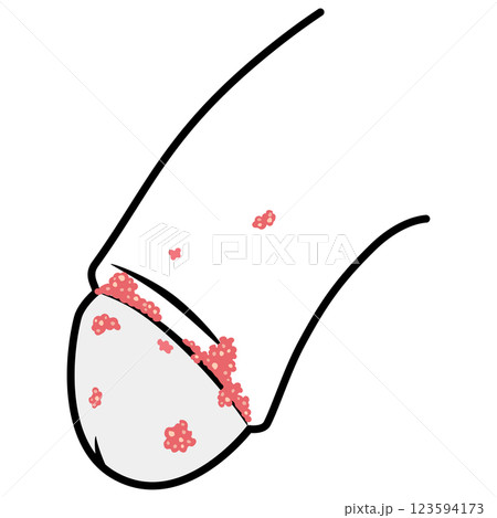 尖圭コンジローマ 男性生殖器にできたぶつぶつ 尖圭コンジローマ 男性生殖器にできたぶつぶつ 123594173