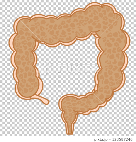 Melanosis coli Melanosis coli 123597246