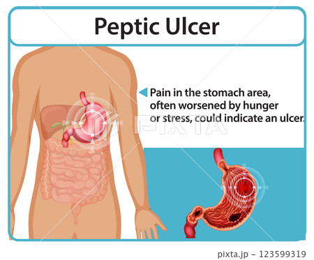 Understanding Peptic Ulcers and Symptoms 123599319
